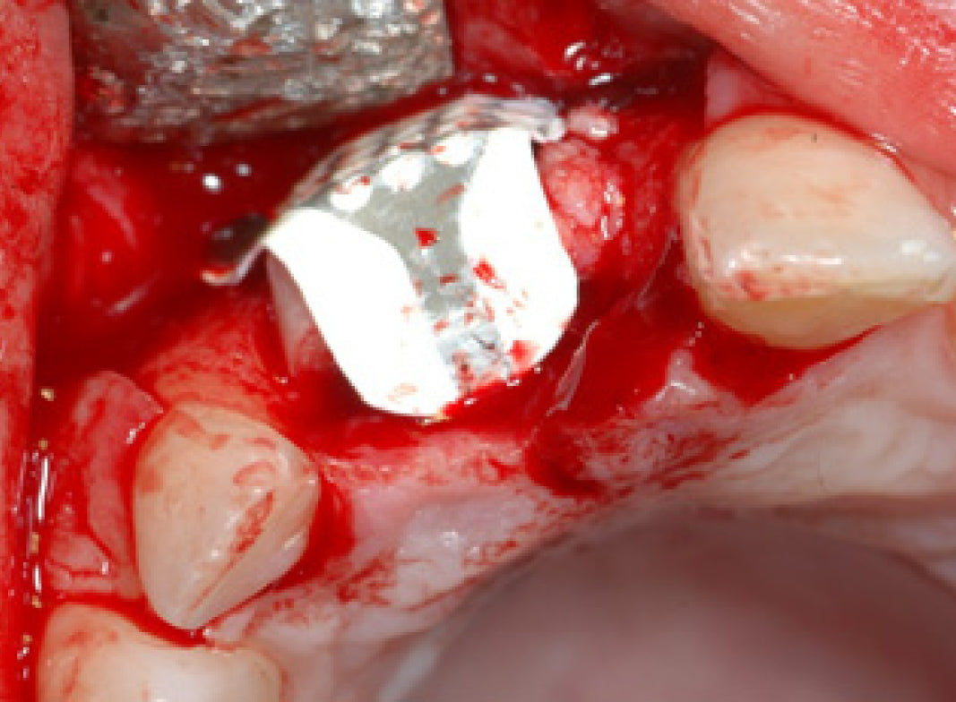 NeoGen Ti-Reinforced Membraner 34 x 25 mm