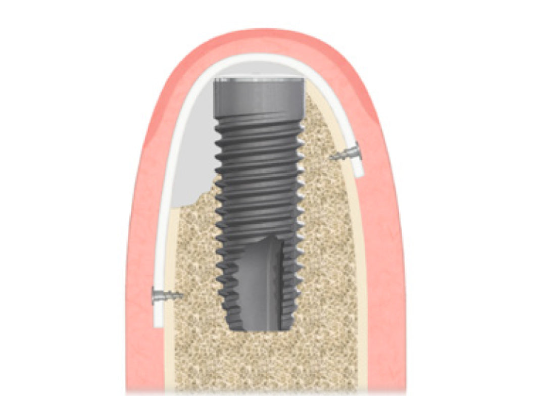 NeoGen Ti-Reinforced Membraner 34 x 25 mm