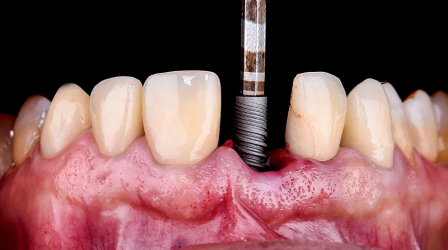 Peri-implantitis: hvad er nyt i behandlingen?