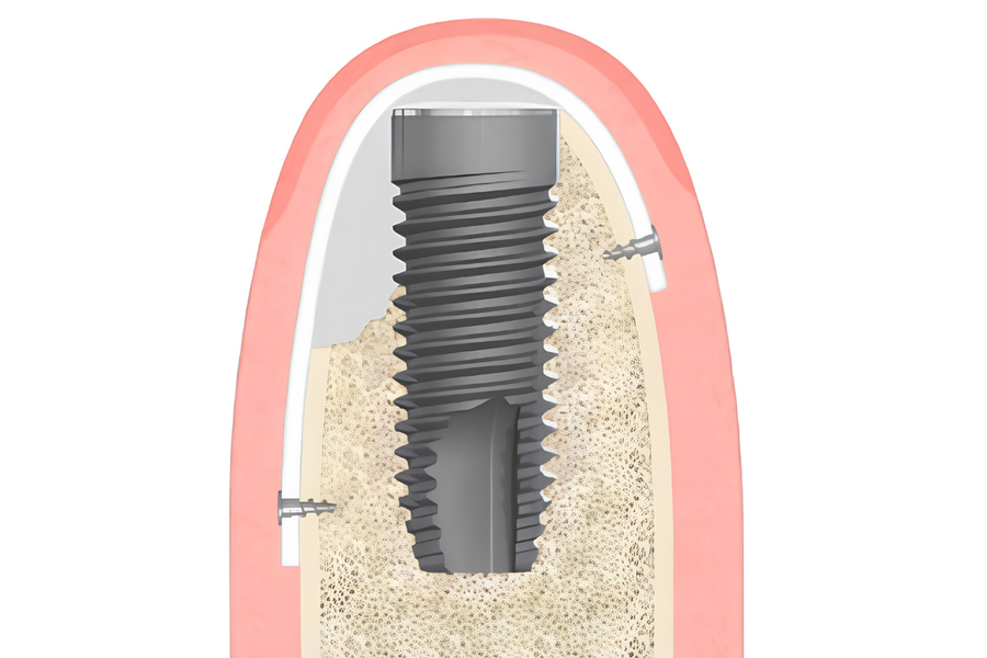 Hvad er GBR? Guided Bone Regeneration og barrieremembraner