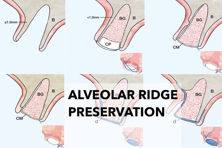 Coverbillede til webinaret Alveolar Preservation: Decisions Based on Bone Morphology