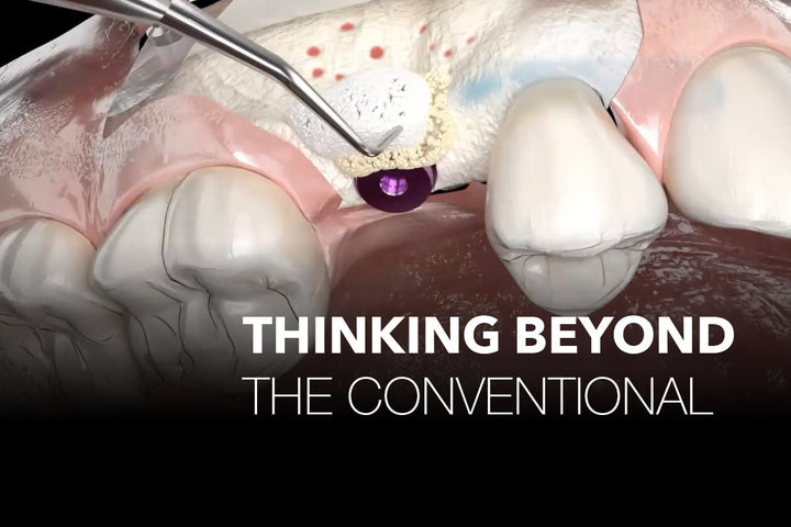 Coverbillede til webinaret Innovative Clinical Solutions for Implant Cases in the Aesthetic Zone: Thinking Beyond the Conventional – Cases Discussion
