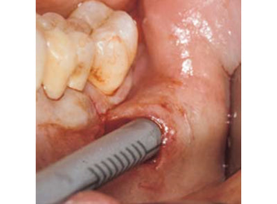 Micross Tunnel harvesting technique bone scraper