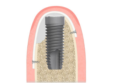 NeoGen Ti-Reinforced Membraner 29 x 14 mm