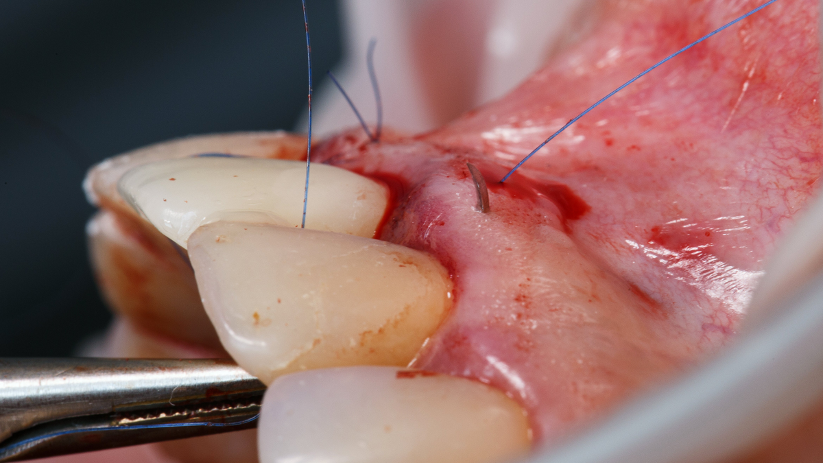 Resorbable sutures